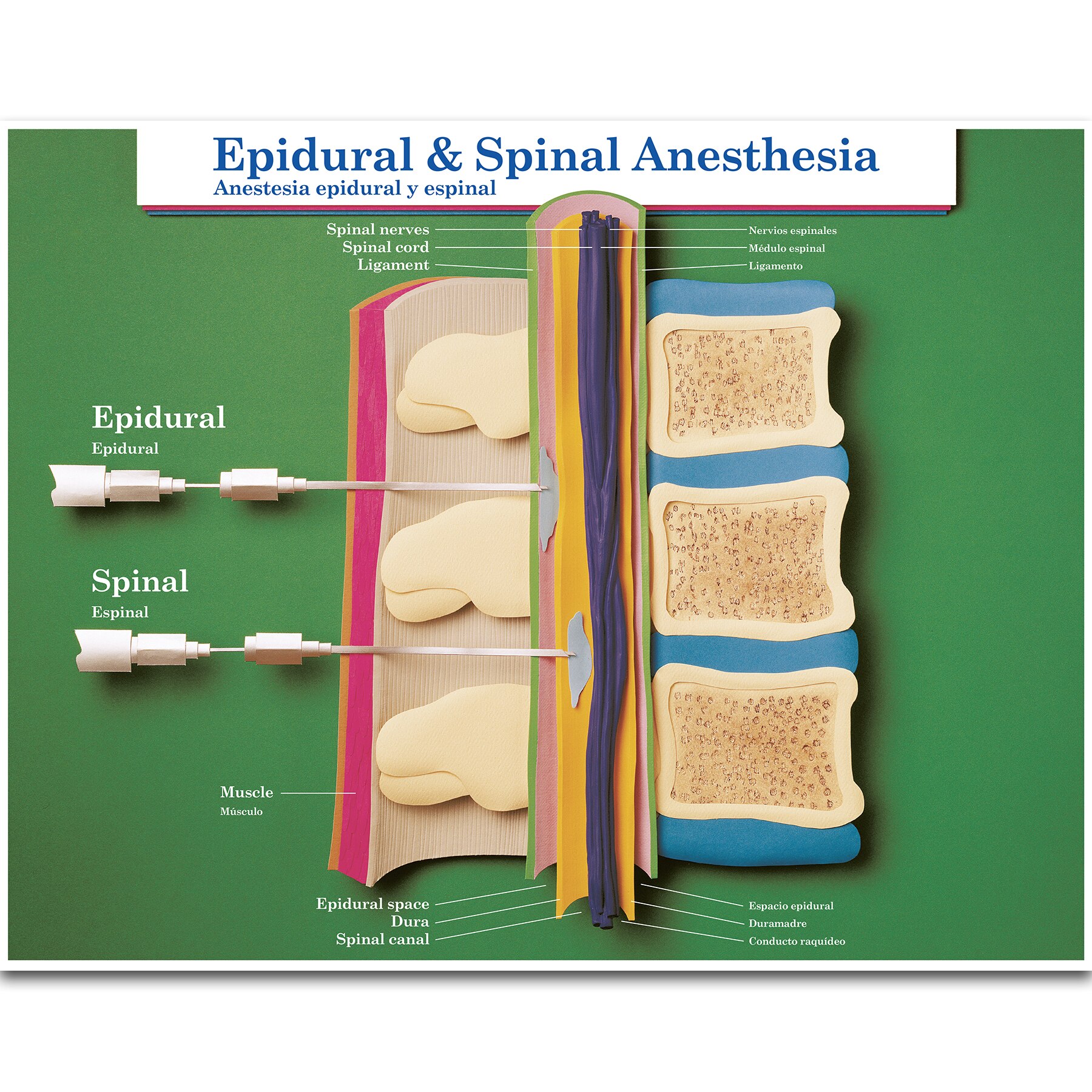 Spinal anesthesia discharge criteria picture
