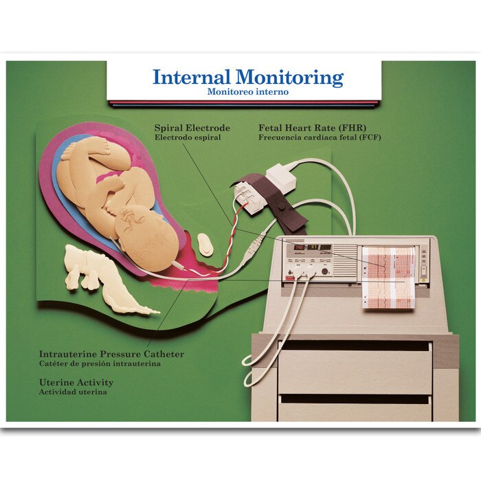 Internal Monitoring Chart, childbirth education chart in the Labor & Birth Intervention Chart Set, Childbirth Graphics, 90615
