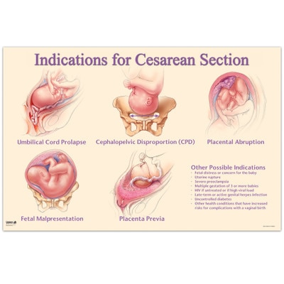 Indications for Cesarean Chart, childbirth education teaching chart with medical illustrations, Childbirth Graphics, 90822