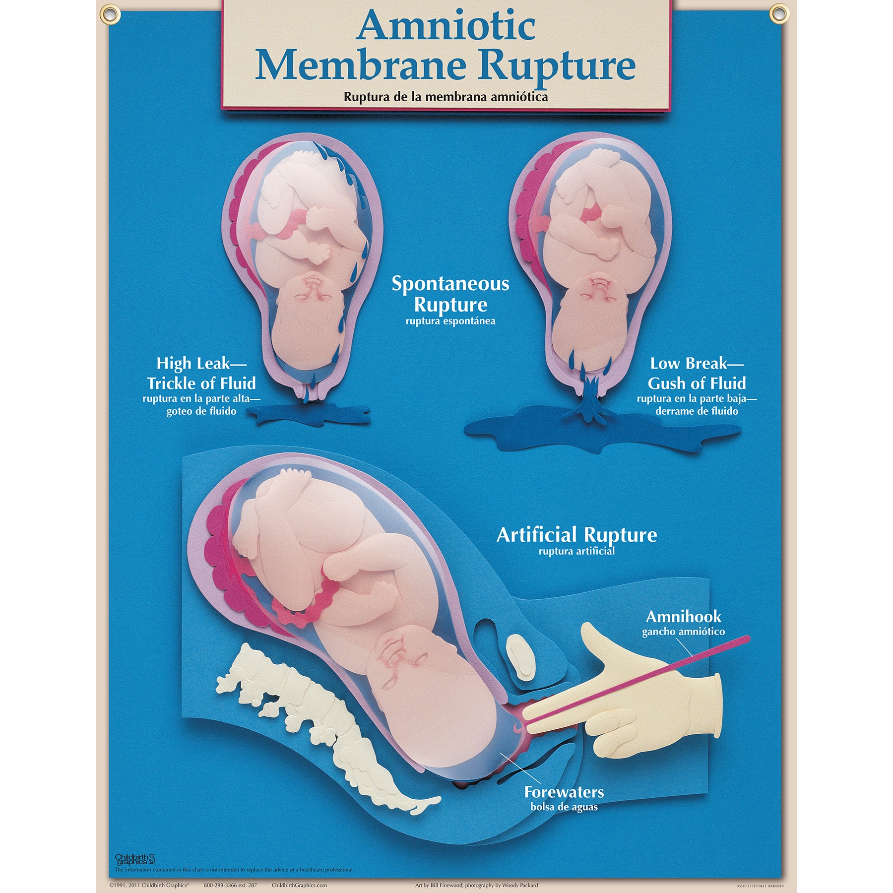 Amniotic Membrane Rupture Chart for childbirth education from Childbirth Graphics