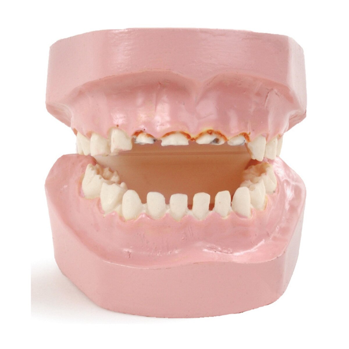 baby bottle tooth decay dental model