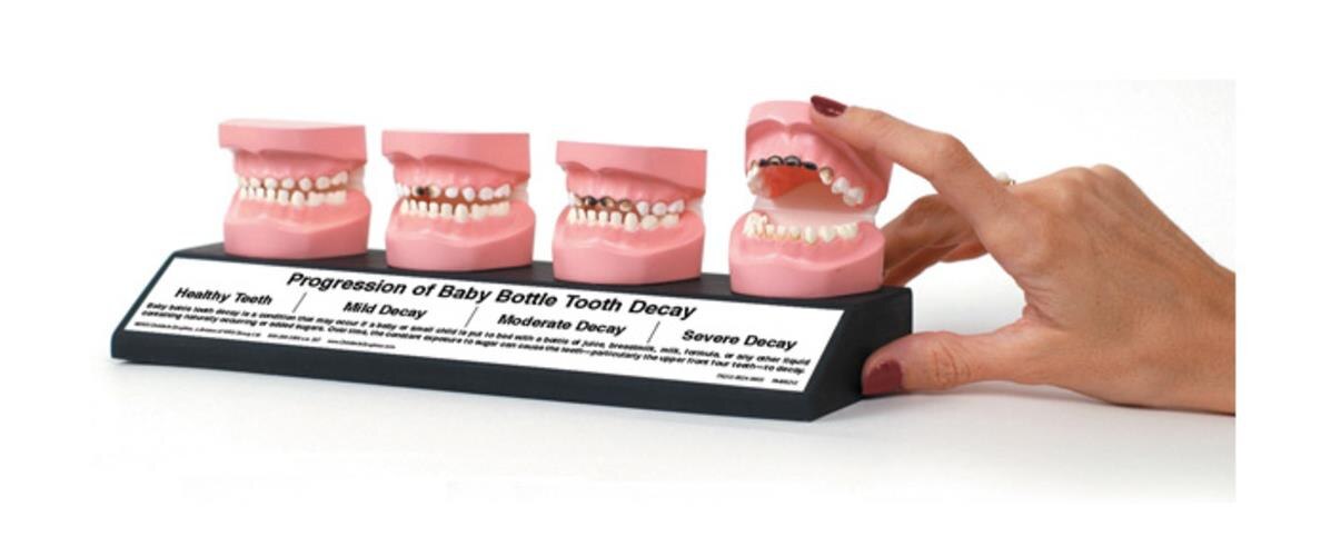 baby bottle tooth decay progression dental models