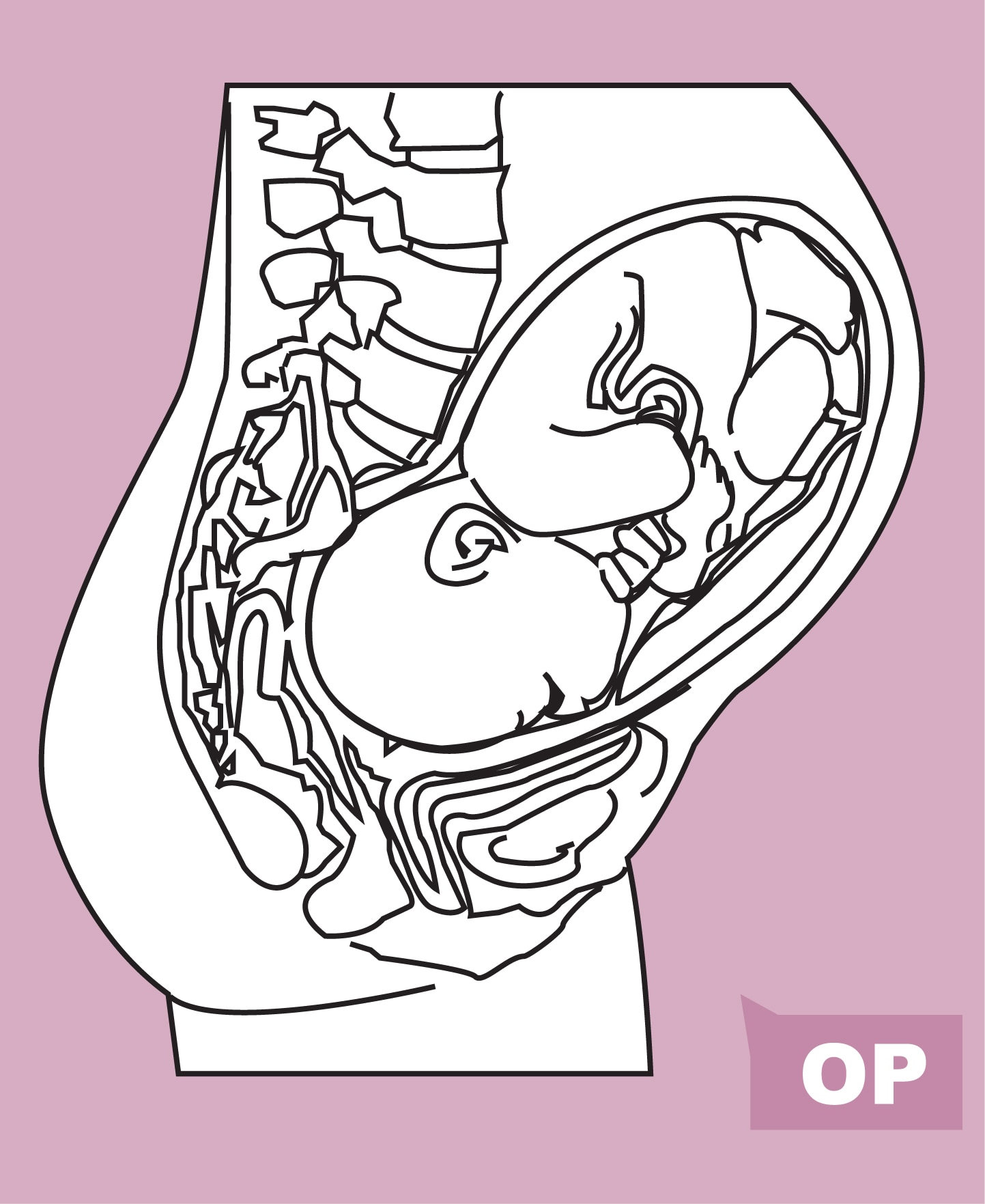 Baby in occiput posterior position