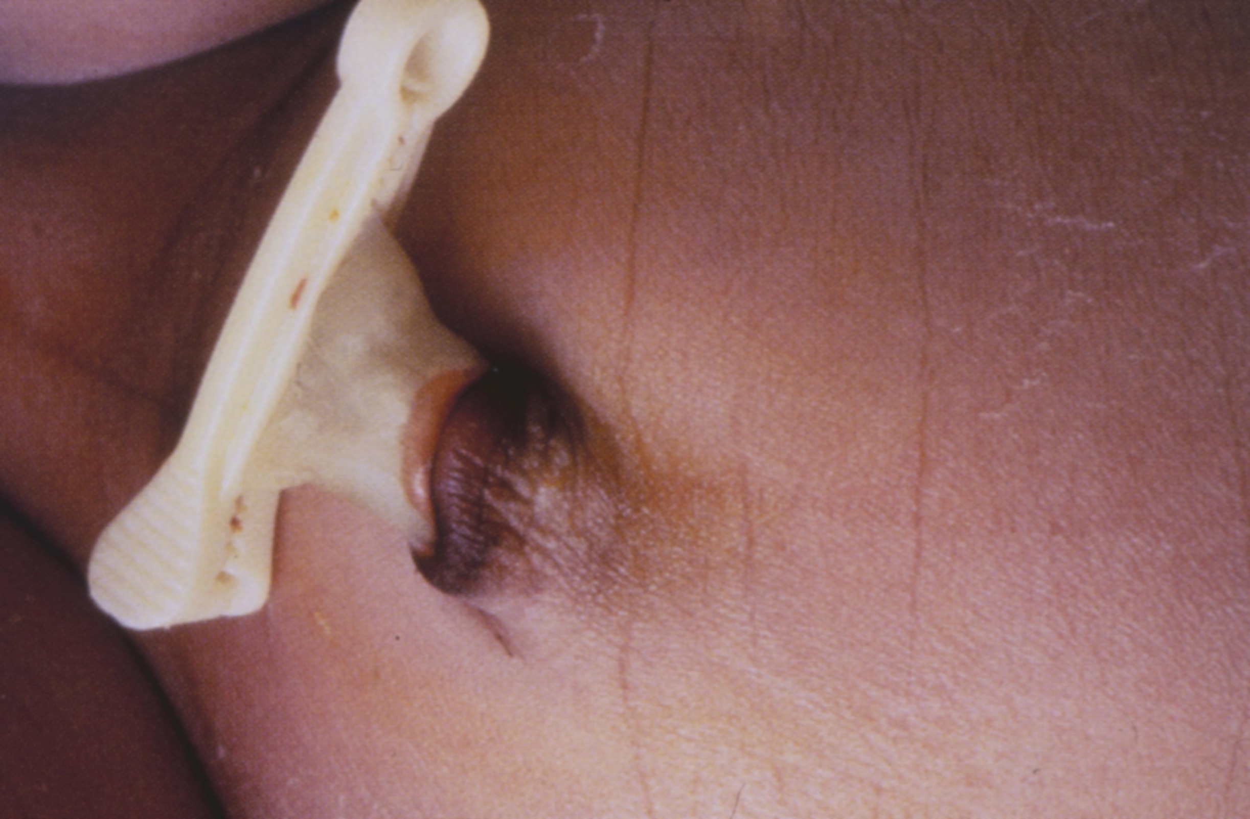 Close-up of newborn with umbilical cord clamping, Childbirth Graphics childbirth education materials and models