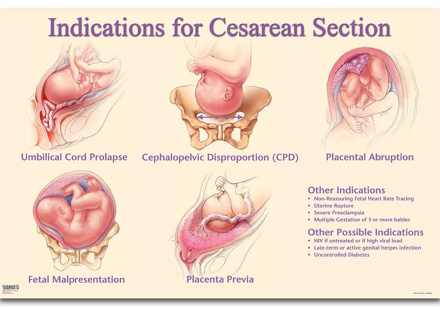 Indications for Cesarean Section Chart for childbirth education from Childbirth Graphics