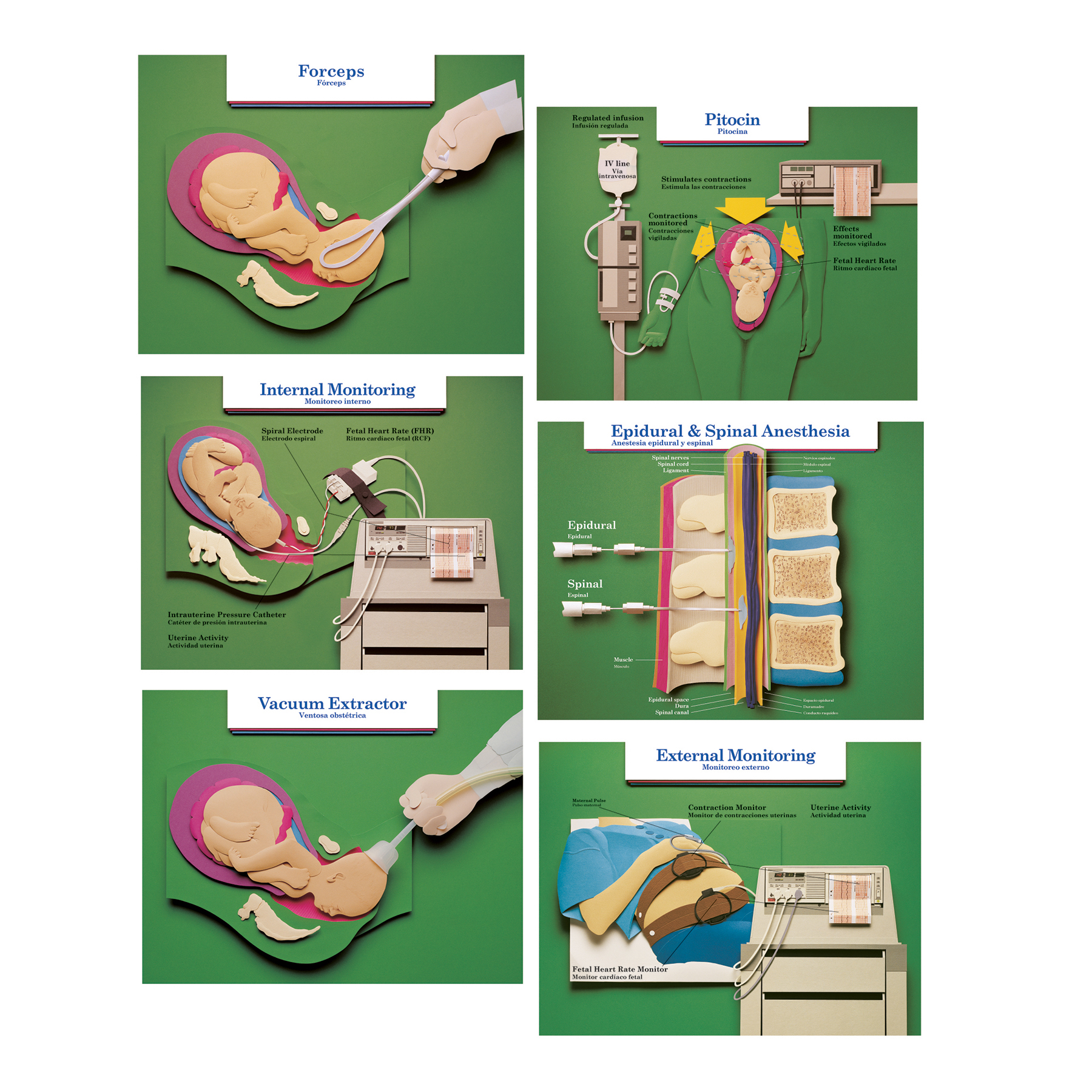 Labor and Birth Intervention Chart Set of 6 for childbirth education from Childbirth Graphics