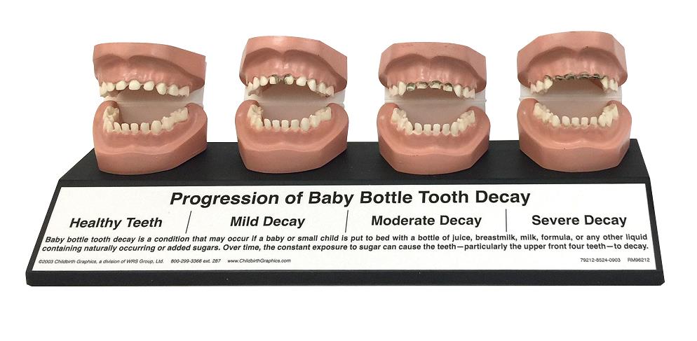 Progression of Baby Bottle Tooth Decay Display