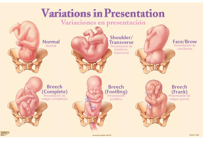 Variations in Presentation Chart for childbirth education from Childbirth Graphics